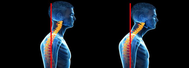 The Most Effective Approach to Posture Improvement